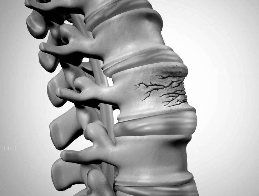 Fracture par tassement dos vertèbre colonne vertébrale
