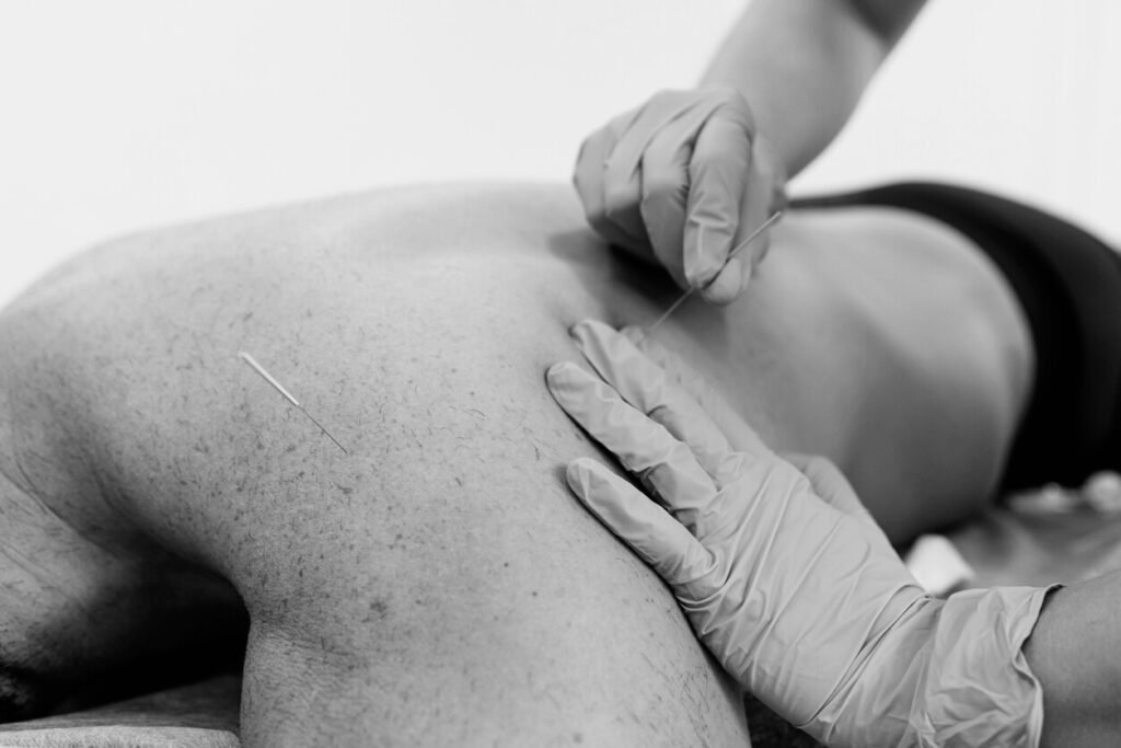 Dry needling douleur ᐅ CAREA Kiné sport Paris