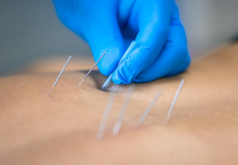 dry needling kiné efficacité