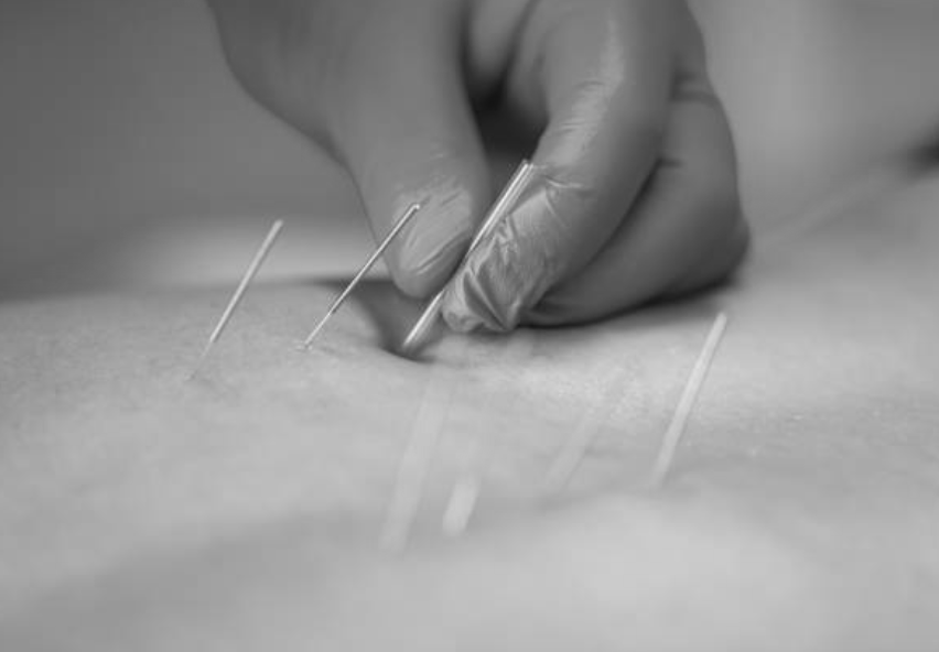 Dry needling efficacité