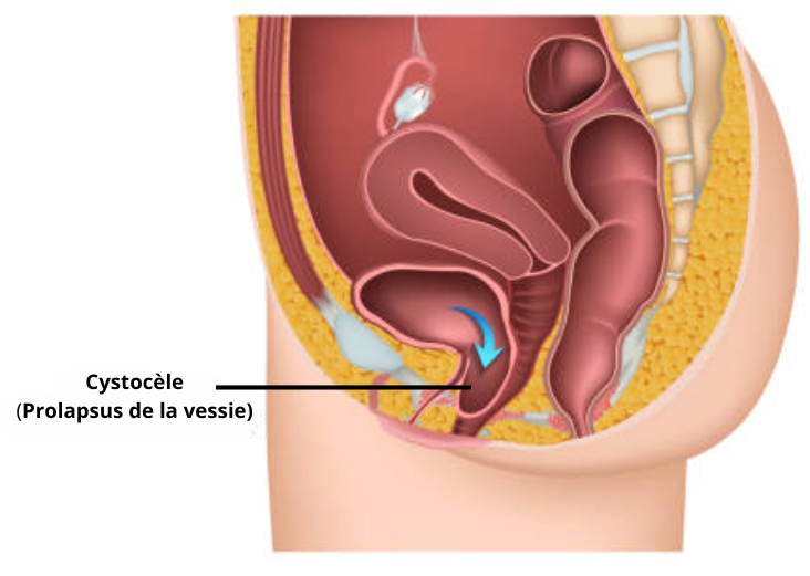 cystocèle