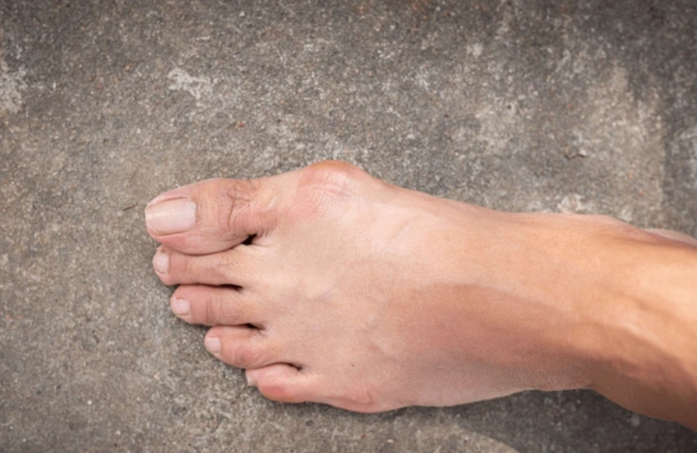 hallux valgus (oignon au pied)