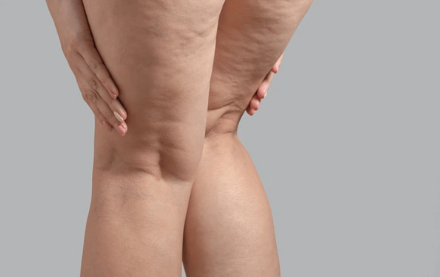 lipoedème jambes